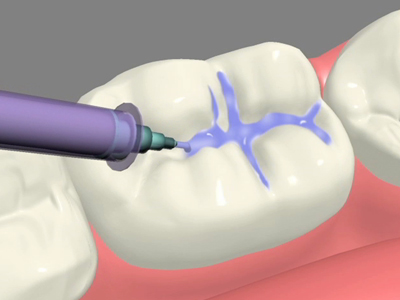 Dental Sealants: Seal Out Tooth Decay