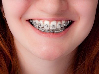 What Is a Good Time for Kids to Get Braces?