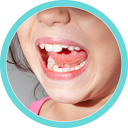 Close up of a child with crooked teeth opening their mouth wide