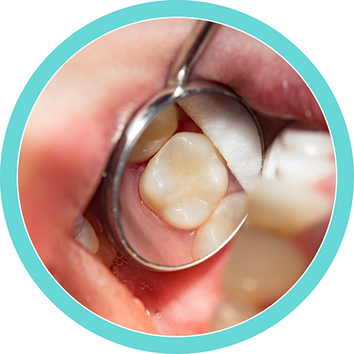 Close up of a dental mirror in a mouth