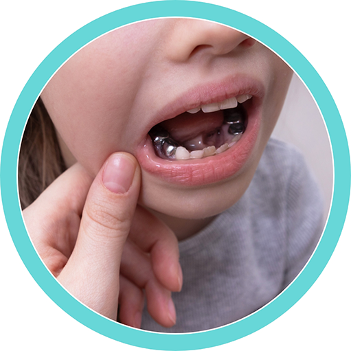 Child's mouth with several silver dental crowns