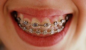 Dental Braces for Adults EL Paso TX
