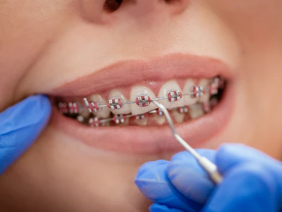 Affordable Dental Braces in El Paso for All Age Groups
