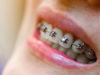 Dental Braces in El Paso showing close-up metal orthodontic brackets improving smile alignment results