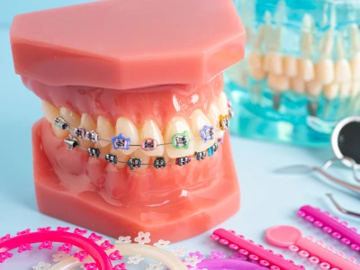 Dental Braces in El Paso showing orthodontic model with metal brackets, wires, and tools for treatment planning