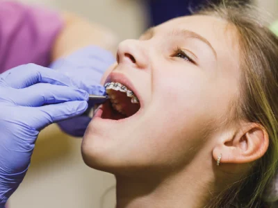 Expert Tips for First-time Dental Braces in El Paso