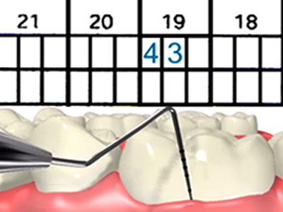 Scaling and Root planing in El Paso TX: What You Need to Know?