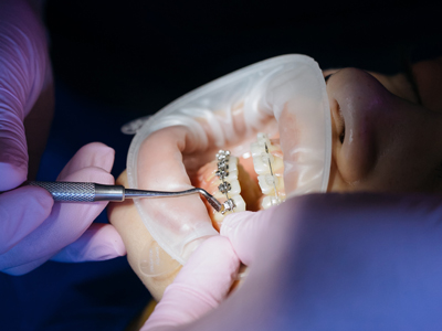 4 Signs Your Kid's Need Orthodontics Treatment | El Paso