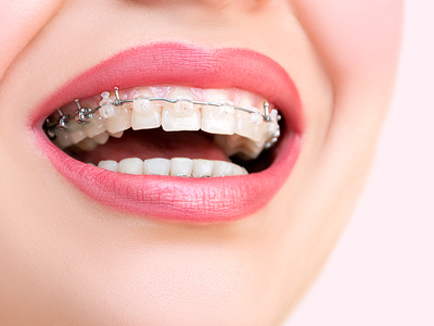 What Are The Latest Advances in Braces?