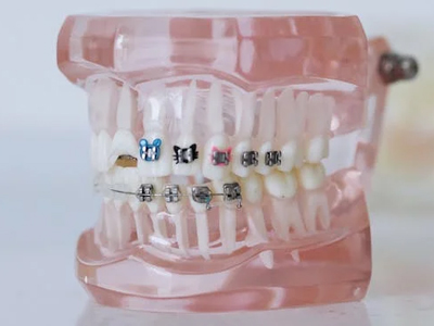 When to Choose Traditional Dental Braces for Kids | El Paso