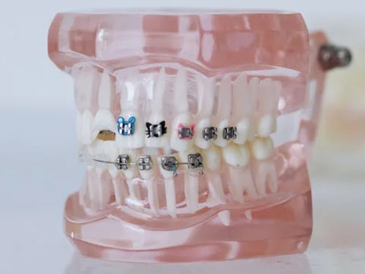 What Do Rubber Bands Do For Braces?, Tender Smiles 4 Kids