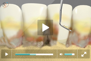 Advanced Periodontitis