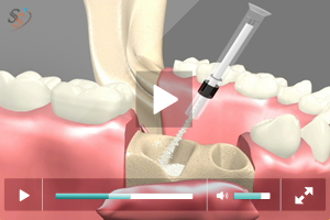 Bone Grafting - Scenario I