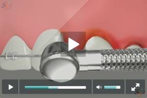 Crown Lengthening(With Laser Tool) - Scenario V