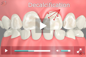 Decalcification On Tooth Decay
