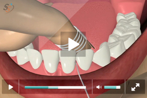 Flossing / Interdental Aids