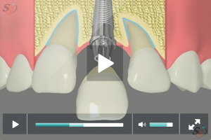 Implant Restoration - Option 1