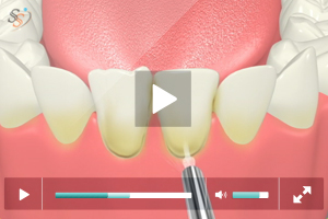 Laser Mandibular Veneers Removing