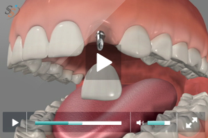 Mini Implants In Maxillary Lateral Incissor