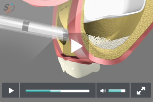 Sinus Grafting