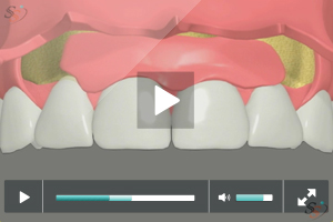 Soft Tissue Grafting - Scenario I