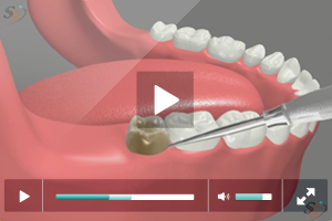Third Molar Extraction - Erupted Tooth (Mandibular)