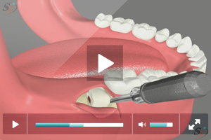 Third Molar Extraction - Horizontal